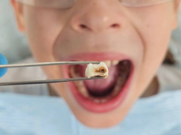 Best Emergency Wisdom Teeth Removal in Coldstream, KY